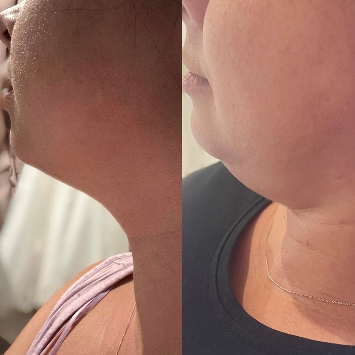 Fat dissolving injections at Vybe Beauty